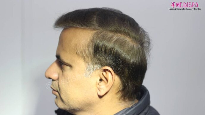 11600 Grafts in 3 FUT Sittings by Dr Suneet Soni photo