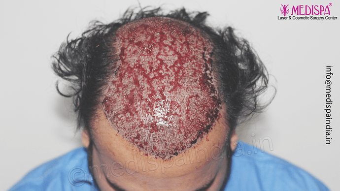 Dr. Suneet Soni - 5467 Grafts, Combine FUT + FUE + Beard Technique, NW- V, 3 Years Result photo