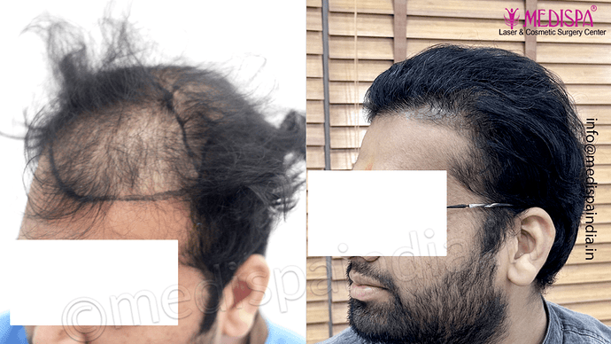 Dr. Suneet Soni - 5467 Grafts, Combine FUT + FUE + Beard Technique, NW- V, 3 Years Result photo