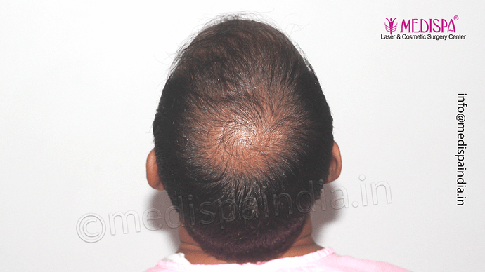 Dr. Suneet Soni - 4533 Grafts, Combine FUT + FUE Technique , NW-IV/V photo