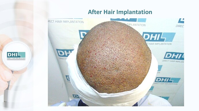DHI India™ | NW 3 | 4,821 Grafts | 1 year DHI Hair Transplant Results photo