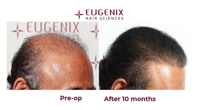 Eugenix Hair Sciences| NW 7 | 6309 Grafts | 10 Months Post-op| Dr. Pradeep Sethi photo