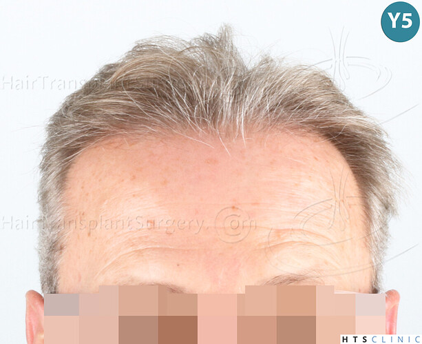 Dr Devroye + Dr Montesanti + Dr Jenard / 7015 grafts (4512 FUT + 2503 FUE) / 2 sessions photo