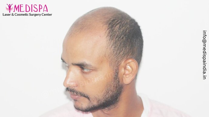 Dr. Suneet Soni - 5294 Grafts, Combine FUT + FUE + Beard Technique, NW- VI, 2 Years Result photo