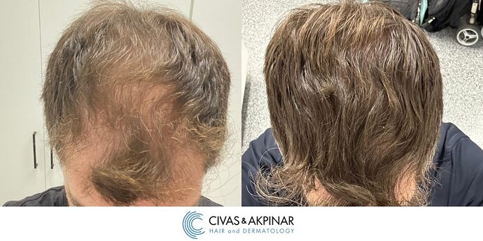 Civas&Akpınar Hair Transplant- FUE Hair Transplant Before & After Pictures (3200 Grafts) photo