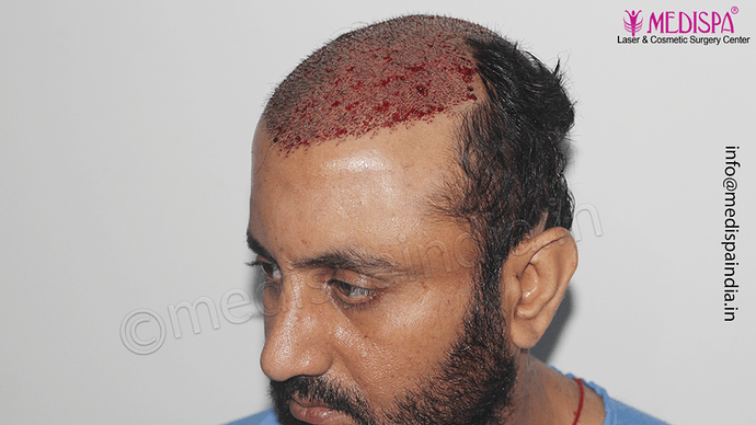 Dr. Suneet Soni - 5334 Grafts, Combine FUT + FUE + BHT (Beard) Technique, NW- V photo