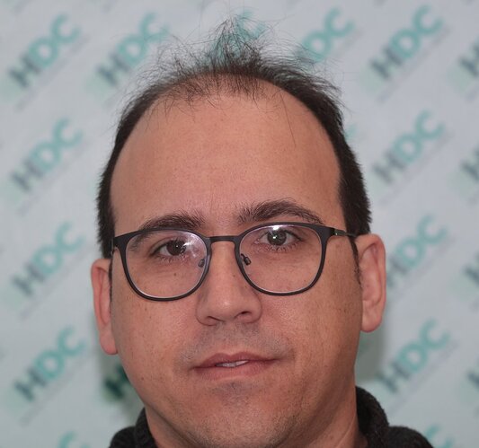 HDC Hair Clinic – FUE Hair Transplant Result for 4534 Grafts photo