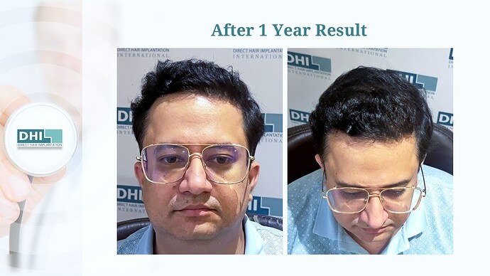 DHI India™ | NW 5 | 3,323 Grafts | 1 Year Hair Transplant Result photo