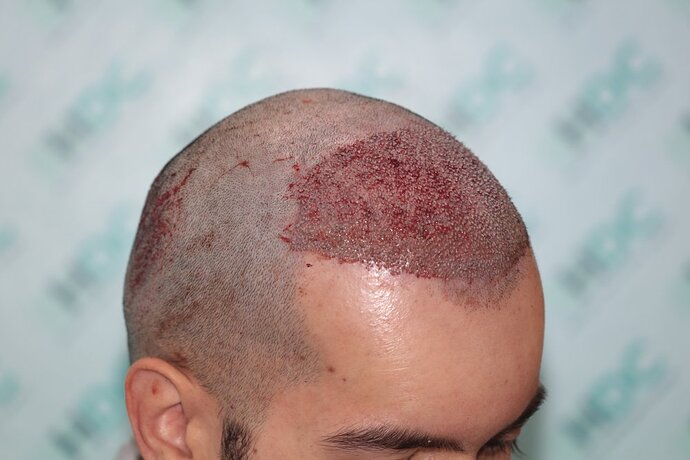 FUE Hair Transplant Result for 3100 Grafts - NW3 – 8 Months After – HDC Hair Clinic photo