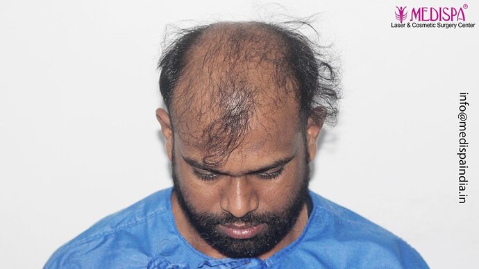 Dr. Suneet Soni - 5498 Grafts, 2 Years Result, Combine FUT + FUE + Beard Technique, NW-VI photo