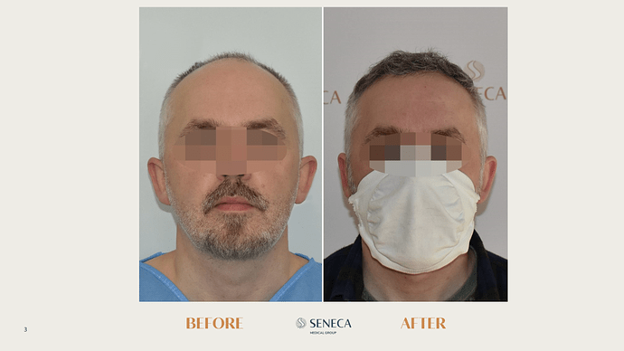 Seneca Medical Group - 1454 grafts with Direct FUE photo