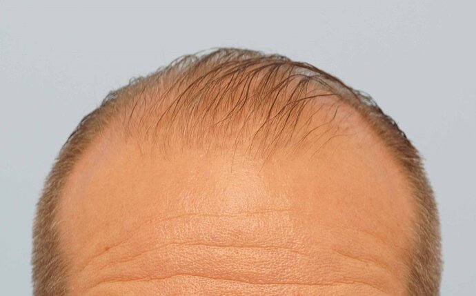 Dr B Farjo 1700g FUE (Front) photo