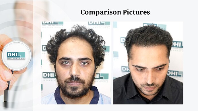 DHI India | NW 4 | 1,833 Grafts | 10-Months DHI Hair Transplant Results photo