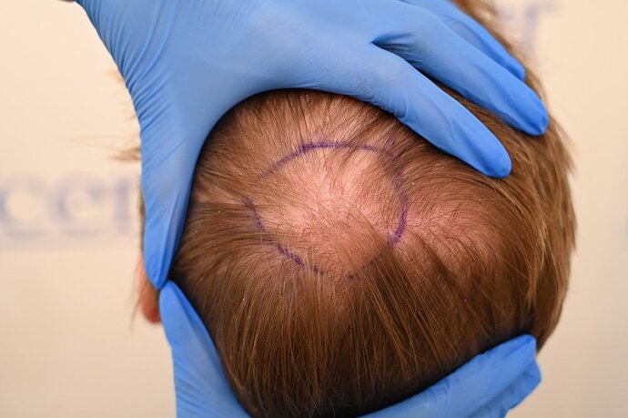 Ozlem Bicer MD-Hair Transplant-2720 Grafts FUE by micro-motor, 9. months result photo