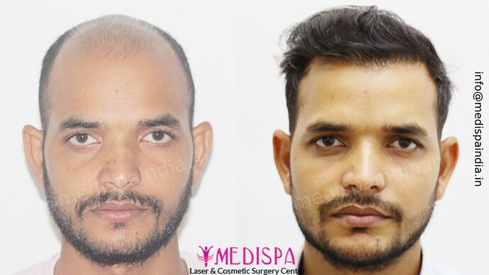 Dr. Suneet Soni - 5294 Grafts, Combine FUT + FUE + Beard Technique, NW- VI, 2 Years Result photo