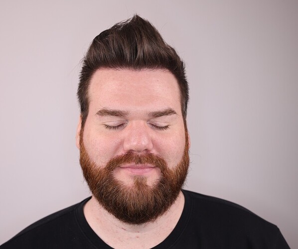 AlviArmani Beverly Hills Hair Restoration result - 3,059 grafts fue photo