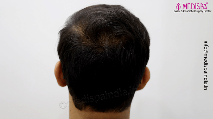 Dr. Suneet Soni - 4665 Grafts, Combine FUT + FUE + BHT (Beard) Technique photo