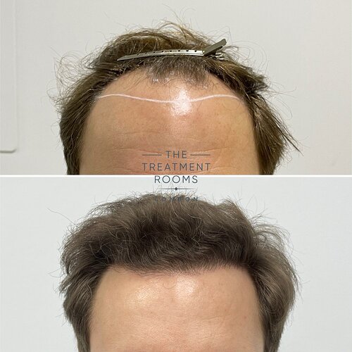 2037 Grafts Hairline and Crown Result- The Treatment Rooms London photo