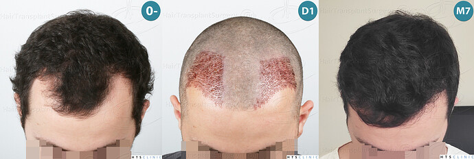 Dr. Jean Devroye, HTS Clinic / 2101 FUE / Temple corners restoration photo