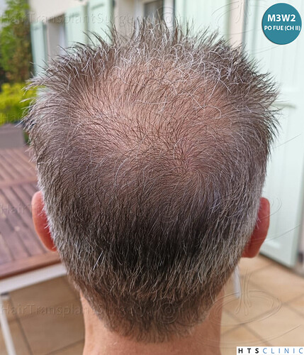 Dr Devroye + Dr Montesanti + Dr Jenard / 7015 grafts (4512 FUT + 2503 FUE) / 2 sessions photo