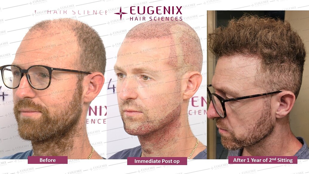 https://cdn.forumhairtransplant.com/optimized/3X/2/3/23b27a2b43176534588f47816cc2bd4932505d54_2_1035x582.jpeg