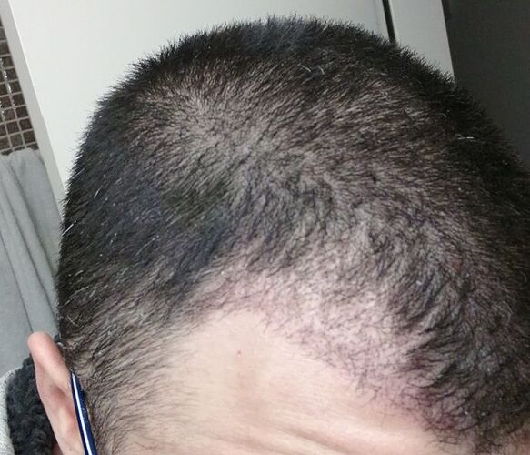 Dr. Bisanga, BHR Clinic, 1660 FUE / 0-7,5 Months photo