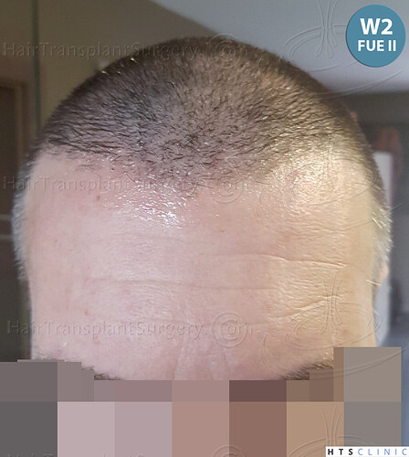 Dr. Jean Devroye, HTS Clinic / 5913 grafts (3036 FUE + 2877 FUE-BHT) / 2 sessions photo