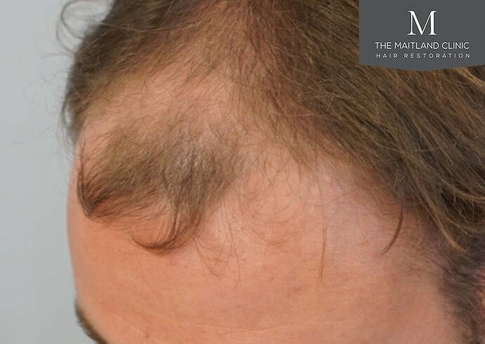 Dr Edward Ball-The Maitland Clinic. 1844 grafts by FUE photo