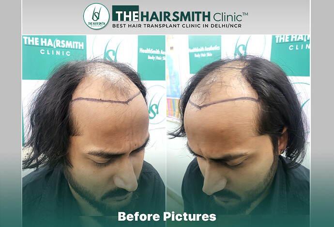 The HairSmith Clinic Delhi | NW Stage 6 | 3785 Grafts | 11 Months Hair Transplant Result photo