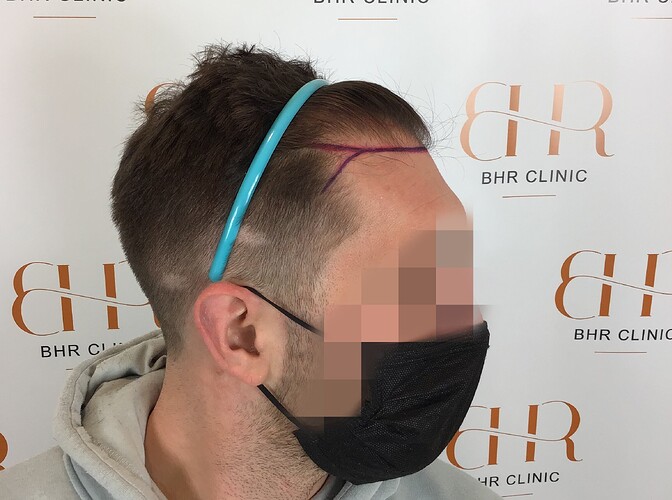 Dr.Bisanga, BHR Clinic 2858 FUE 0 - 8 Months Hair Transplant Fast, Dense & Natural Growth photo