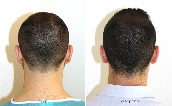 Case performed by Dr. Feriduni – 3505 FU in 1 procedure photo