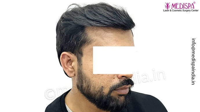 Dr. Suneet Soni - 3029 FUE Grafts, FUE Method (Trivellini System), NW - III photo