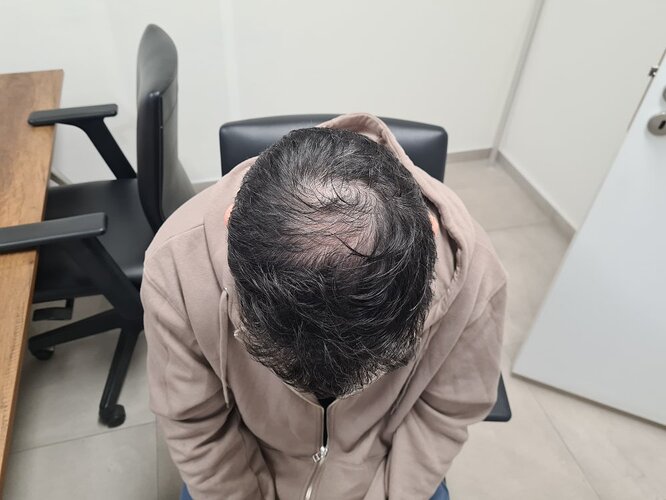 FUE Result for 4400 Grafts – 6 Months after – HDC Hair Clinic photo