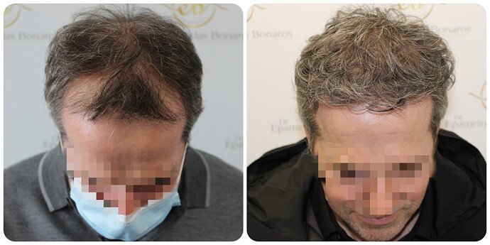 Dr Bonaros, Glasgow, UK / 3595 FUE grafts / 0-12 Months photo