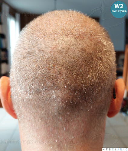 Dr Devroye + Dr Montesanti + Dr Jenard / 7015 grafts (4512 FUT + 2503 FUE) / 2 sessions photo