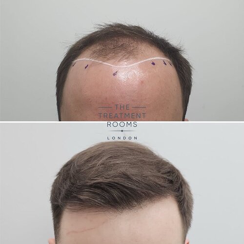 Result- Frontal Third FUE Hair Transplant- 2187 Grafts photo