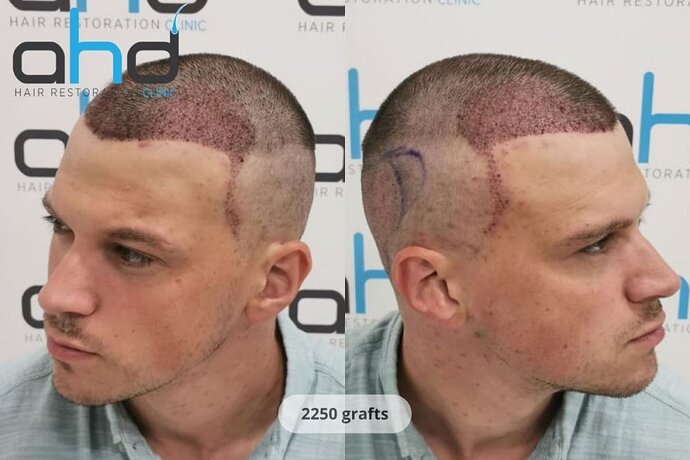 AHD Clinic / Technicians / 2250 grafts / FUE + DHI photo