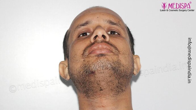 Dr. Suneet Soni - 4500 Grafts, Combine FUT + FUE Technique, NW-III photo