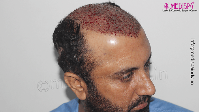 Dr. Suneet Soni - 5334 Grafts, Combine FUT + FUE + BHT (Beard) Technique, NW- V photo