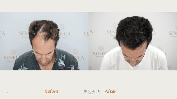 Seneca Medical Group - 1700 grafts with Direct Fue photo