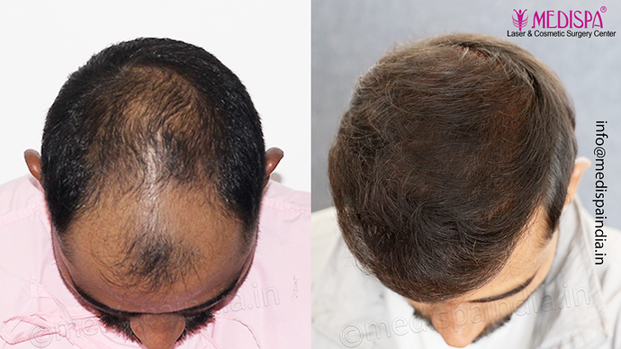 Dr. Suneet Soni - 5360 Grafts | 12-Month Result | Combination FUT + FUE + Beard photo