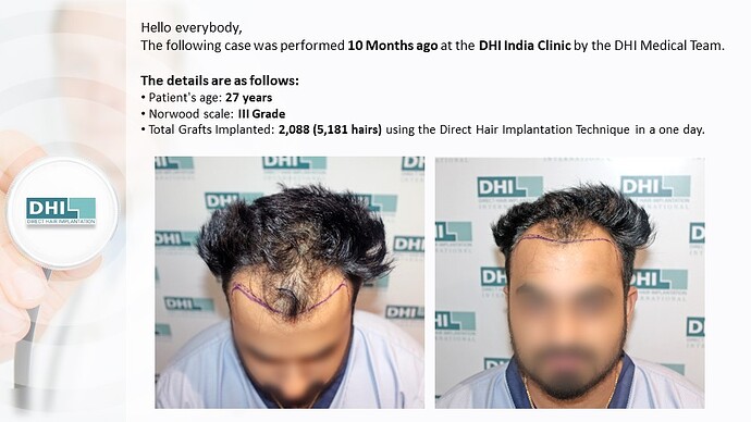 DHI India | Hair Line Reconstruction | Grade 3 | 2,088 Grafts | 10 Months Hair Transplant Results photo