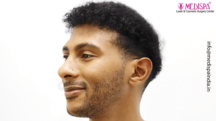 Dr. Suneet Soni - Afro Hair Transplant, 2 Sessions, 8355 Grafts, Combined FUT + FUE Technique, NW-VI, 5 Years Result photo