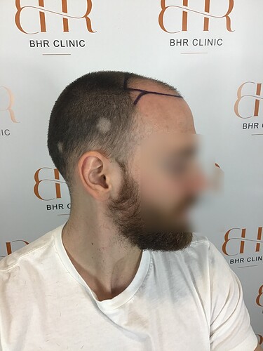 Dr. Kostis BHR Clinic Brussels - 2950 FUE 0 - 5 Months photo