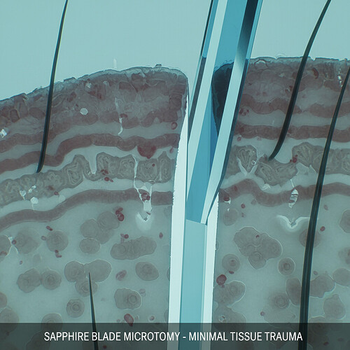 Microscopic view of a scalp channel created by a sapphire blade.