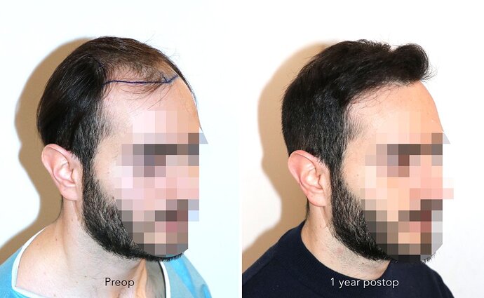 Case performed by Dr. Feriduni – 3744 FU in 1 procedure photo