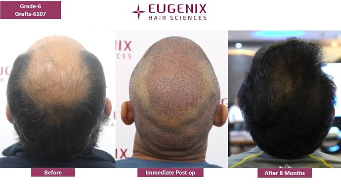 EUGENIX HAIR SCIENCES | NW 6 | 8 MONTHS RESULT | photo