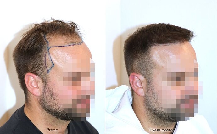 Case performed by Dr. Feriduni – 3726 FU in 1 procedure photo