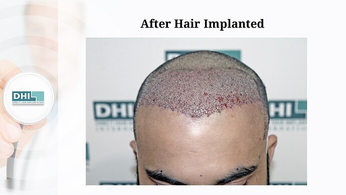 DHI India | Hair Line Reconstruction | Grade 3 | 2,088 Grafts | 10 Months Hair Transplant Results photo