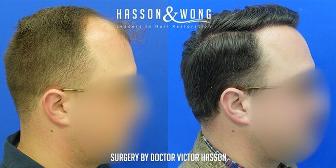 Dr. Hasson / 4,511 grafts / FUE / Frontal zone /mid / 3 years post-op photo